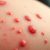 Alergia skórna – przyczyny, objawy i skuteczne sposoby leczenia